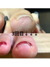 究極のワンカラー専門店/ワイヤーを使わない巻爪矯正