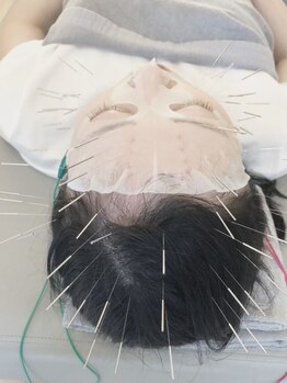 経堂鍼灸整体院の写真/幹細胞の力でハリ艶がUP☆試しやすい価格帯で美容鍼が初めての方にも◎しわ,たるみ,顔のコリを改善します♪