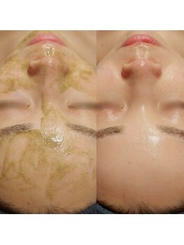 マイフェアレディ 今池(MyFairLady)/【韓国発祥】ハーブピーリング