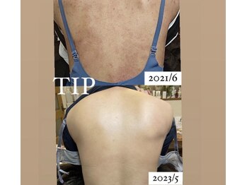 ムーンリズム(Moonlism)/【TIPハーブ症例】