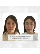 ルシエル/糸リフト級の変化を、手で叶える