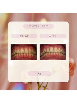 プラスビー 2号店(+b)/ホワイトニングビフォーアフター