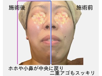 アイリー(iley)/ビフォーアフター