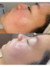 ゴールド 栄店(GOLD)/毛穴洗浄コース 3回後