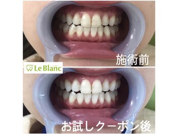 ルブラン 奈良店(Le Blanc)/ホワイトニングする歯は