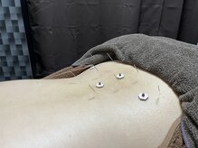 オレンジフラワープラス(orangeflower+)/足がむくむ方には腰の鍼灸施術