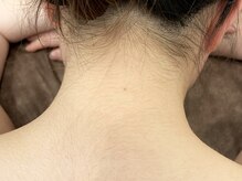 ドクターリバース(Dr.Reverse)/うなじ・背中LED脱毛/佐賀脱毛