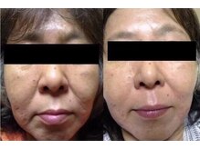 ヒフミ(hifumi.)/復元パック☆症例５