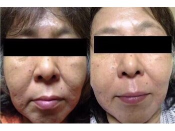 ヒフミ(hifumi.)/復元パック☆症例５