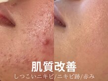 サロン ウーカ(salon WOOCA)の雰囲気（REVI陶肌トリートメント★ダウンタイムなし）