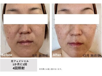 メイ(meiy)/小顔/たるみ/美白/毛穴