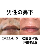 デジール/【メンズ脱毛/ヒゲ脱毛/顔脱毛】