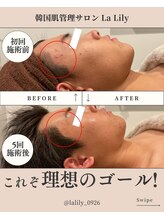 ラ リリー ステラ(La Lily stella)/肌質改善　ニキビレス肌