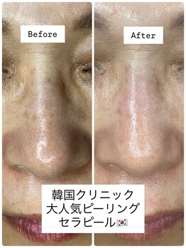 エアージーモ(Air Gmo)/鼻の黒ずみや角栓が気になる方！