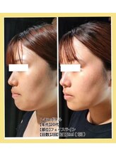 リファイン(REFINE)/顔脂肪撃退！二重アゴ撃退☆