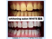 ホワイトニングサロン ホワイト(WHITE)/セルフホワイトニング/大阪/福島