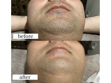 ラウレアサロン(laule'a salon)の雰囲気（後悔はさせません！コンプレックスはなくせます♪#ヒゲ脱毛 ）