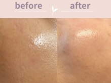 アール(R)/ユンギハーブピーリング