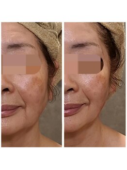 ウォーマル(warmaL)/小顔矯正/シワ たるみを一撃！