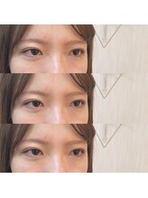 シアミス(SIAMIHS)/トリートメント