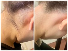 トリディア/えりあし脱毛