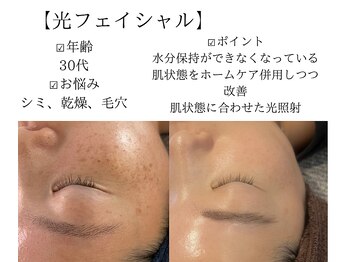 サロンツキ(salon tuki)/光フェイシャル/徳島/シミケア