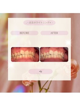プラスビー 2号店(+b)/ホワイトニングビフォーアフター
