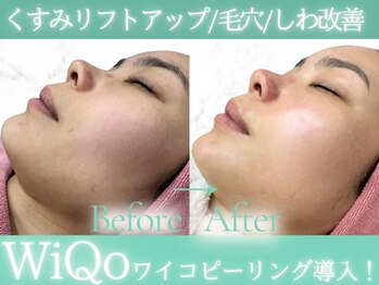 Cスキンケアクリニック 麻布店/WiQoピーリングビフォーアフター