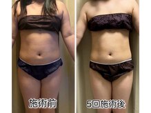 クールスパ(COOL SPA)/【30代女性】お腹症例