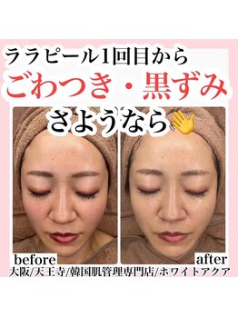 ホワイトアクア 天王寺本店(WHITE AQUA)/ララピール/大阪/天王寺/毛穴