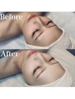 エクリア(ECLIA)/フェイシャル Before⇒After