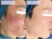 ハービー(Herbee)/最強のニキビケア