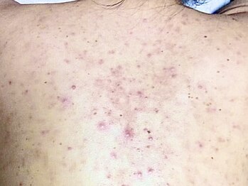 ビズビズ 神戸店(bisebise)の写真/背中改善専門【背中ニキビケア】ピーリング+ハイドラ毛穴洗浄+フォト￥8800二の腕お尻も◎