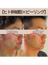 モーイエンチャーム(mooi en charme)/ヒト幹細胞導入×ピーリング