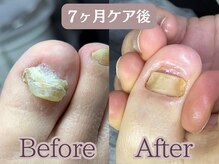 ポドロ(PoDoLo)の雰囲気（【分厚くなった爪】定期的なケアでここまで変化します。）