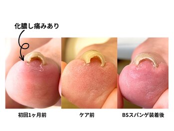 ポドウオーク(PODO WALK)/巻き爪　B/Sスパンゲ