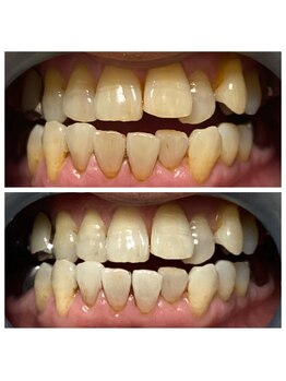 サロン ド ルナ(Salon de Luna)/セルフホワイトニング