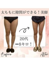 サロン ド ボーテ ラーンジュ 岐阜店(salon de beaut'e L'ange)/ハイパ-ナイフEX2ダイエット痩身