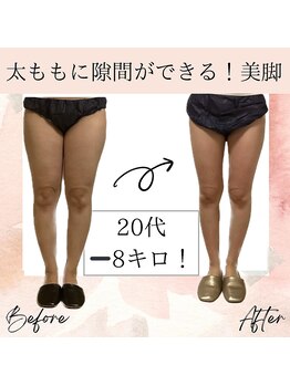 サロン ド ボーテ ラーンジュ 岐阜店(salon de beaut'e L'ange)/ハイパ-ナイフEX2ダイエット痩身