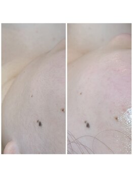 ウォーマル(warmaL)/美肌の近道は除毛から♪