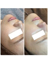 ピエル 北千住店(PIEL)/スペシャルセットで毛穴お肌ケア