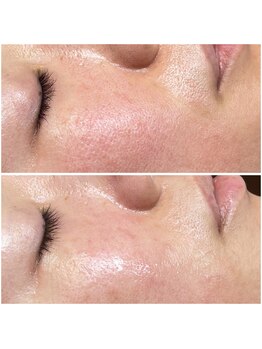 リンク(LiNK)/ハーブピーリング