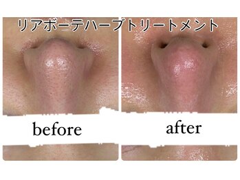 ビノスビューティー(vinos.beauty)/ReL'a BEAUTEハーブピーリング