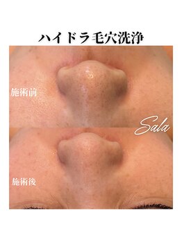 サラ/ハイドラ毛穴洗浄