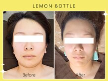 シロカネ 光の森店(SHIROKANE)/レモンボトル×小顔コルギ☆