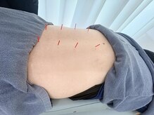 さくらメディネス整骨院 金武院/鍼施術