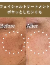 ココロ(COCORO)/ボヤッとシミも