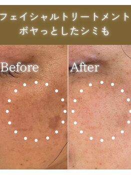 ココロ(COCORO)/ボヤッとシミも