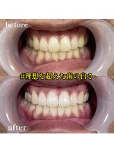 エピリス(Epiliss)/ホワイトニングビフォーアフター