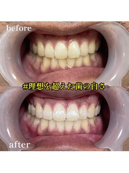 エピリス(Epiliss)/ホワイトニングビフォーアフター